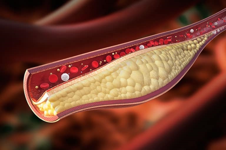 Kolesterol Nedir belirtileri nelerdir