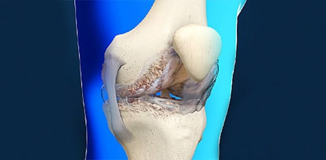 Osteoartrit Nedir