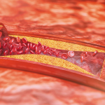 ateroskleroz damar sertligi nedir