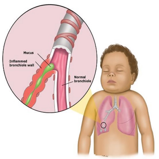 bronsiolit nedir