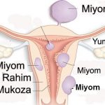 miyom nedir