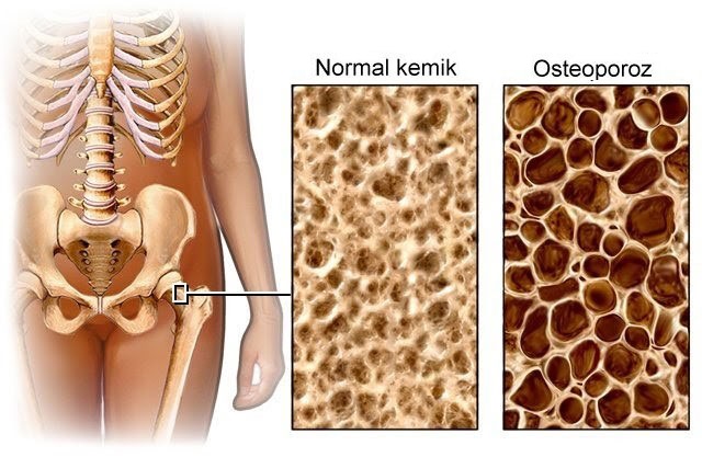 osteoporoz olcme