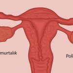 Polikistik Over Sendromu Nedir? Nasıl Tedavi Edilir?