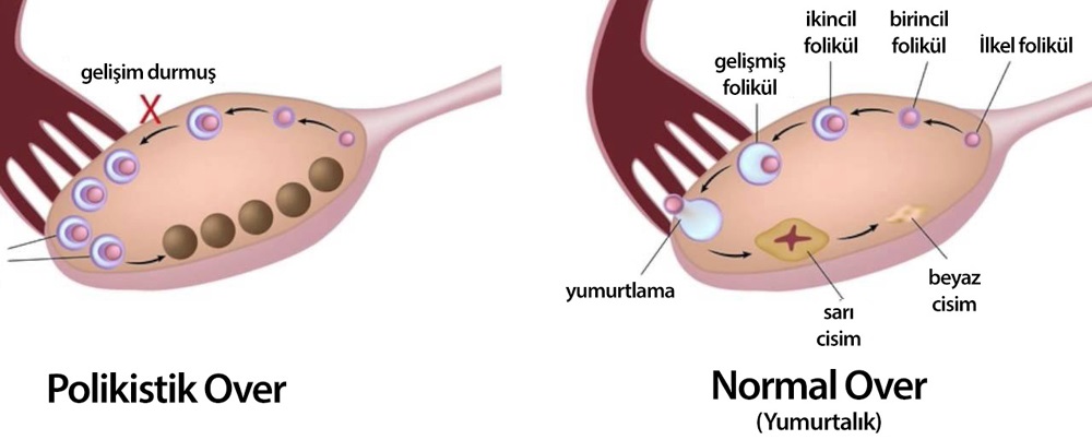 polikistik over sendromu nedir