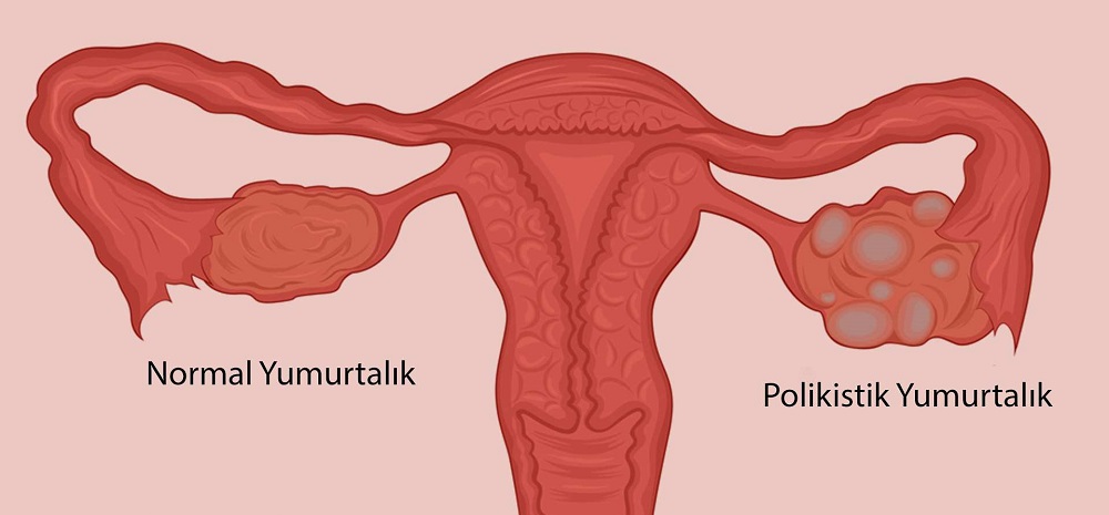 polikistik over sendromu