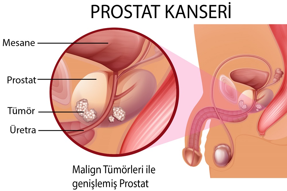 prostat kanseri